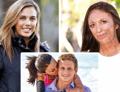 “200 Surgeries And Three Years In Hospital”: The Story Of an Australian Model Who Survived a Terrible Fire And Recovered Thanks To True Love!
