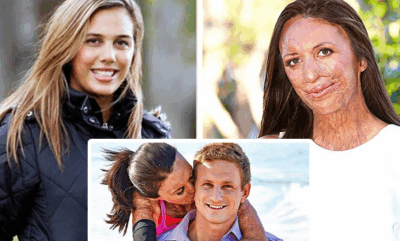 “200 Surgeries And Three Years In Hospital”: The Story Of an Australian Model Who Survived a Terrible Fire And Recovered Thanks To True Love!