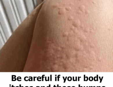 Why do hives appear on the skin? These are the surprising factors you might not know about. Why do hives appear on the skin? These are the surprising factors you might not know about.