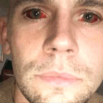 Man issues warning after five-day cocaine binge left him with ‘devil eyes’ and it almost killed him