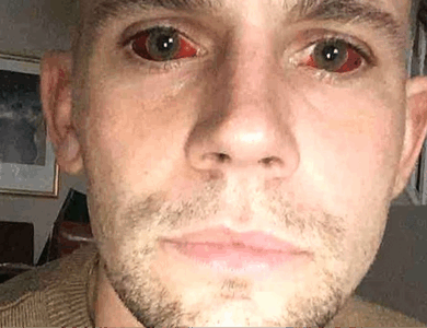 Man issues warning after five-day cocaine binge left him with ‘devil eyes’ and it almost killed him Man issues warning after five-day cocaine binge left him with ‘devil eyes’ and it almost killed him