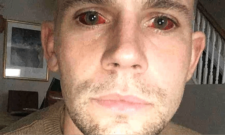 Man issues warning after five-day cocaine binge left him with ‘devil eyes’ and it almost killed him