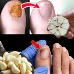 Garlic: The Natural Remedy for Nail Fungus You Can Trust Garlic: The Natural Remedy for Nail Fungus You Can Trust