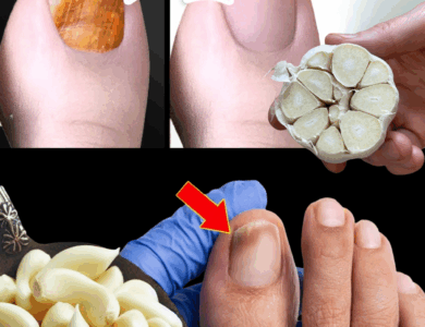 Garlic: The Natural Remedy for Nail Fungus You Can Trust Garlic: The Natural Remedy for Nail Fungus You Can Trust
