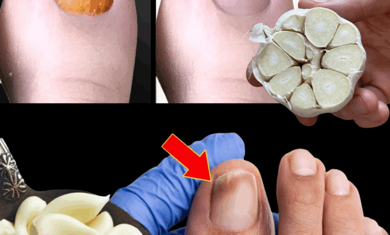 Garlic: The Natural Remedy for Nail Fungus You Can Trust Garlic: The Natural Remedy for Nail Fungus You Can Trust